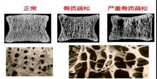 骨质疏松示意图3